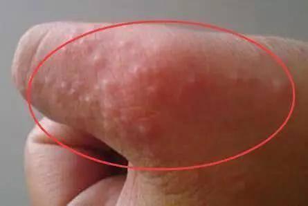 生殖上長小水泡的原因，深度解析與應(yīng)對建議，生殖部位小水泡成因深度解析及應(yīng)對建議