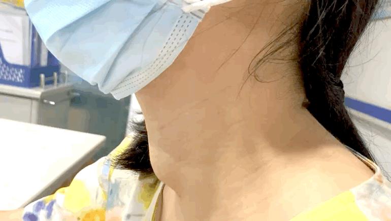 甲狀腺結節(jié)是被氣的嗎？深入了解甲狀腺結節(jié)的成因與防治，甲狀腺結節(jié)成因與防治，情緒因素與疾病關系探討