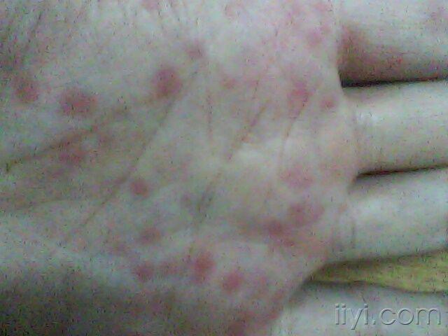 關(guān)于梅毒引發(fā)的紅斑特征及識(shí)別方法，梅毒引發(fā)紅斑的特征與識(shí)別方法指南