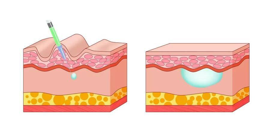 法令紋去除最安全永久的方法，全面解析與實(shí)用建議，全面解析法令紋永久安全去除法，實(shí)用建議與最佳實(shí)踐
