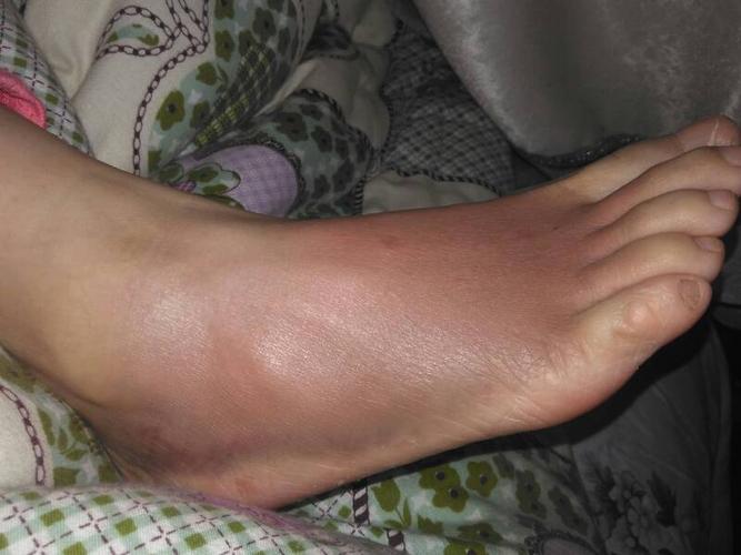 腳腫是什么原因引起的，深度解析腳部腫脹的多元因素，腳部腫脹的深度解析，多元因素引起的腳腫原因探究