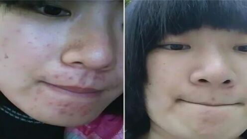 揭秘三天快速去痘印小竅門，輕松恢復肌膚光彩，三天快速去痘印秘訣大揭秘，輕松重塑肌膚光彩