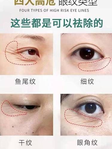 怎樣去除眼角皺紋方法最快，全面解析有效去皺秘訣，快速去除眼角皺紋秘訣，全面解析有效去皺方法