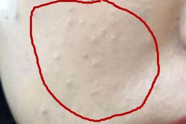 粉刺長什么樣子？圖片解析帶你深入了解，粉刺詳解，圖片解析帶你探索其真實(shí)面貌