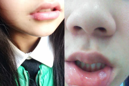 唇上長水泡如何快速消除，原因、治療與預防，唇上長水泡，快速消除、原因分析及治療與預防方法