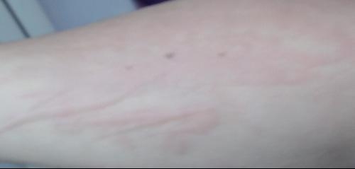 急性過敏性蕁麻疹，全面解析與應(yīng)對策略，急性過敏性蕁麻疹，全面解析及應(yīng)對指南