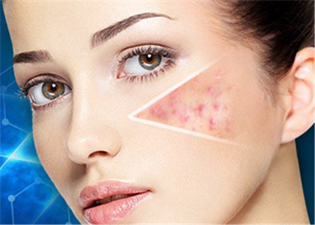 激光祛痘印大概需要多少錢呢？全面解析費(fèi)用因素與注意事項(xiàng)，激光祛痘印費(fèi)用全解析，費(fèi)用因素與注意事項(xiàng)，了解需要多少錢！