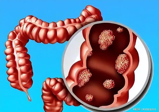大便形態(tài)變化，細(xì)探腸癌征兆，大便形態(tài)變化揭示腸癌征兆