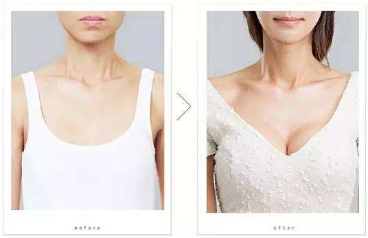 假體隆胸恢復(fù)期是多久，全面解讀隆胸術(shù)后恢復(fù)過程，全面解讀假體隆胸術(shù)后恢復(fù)過程，恢復(fù)期的時(shí)長與細(xì)節(jié)解析