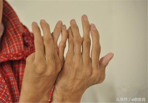 風(fēng)濕性關(guān)節(jié)炎的最佳治療方案，風(fēng)濕性關(guān)節(jié)炎的最佳治療策略或方案