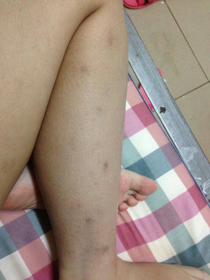 蚊子咬后留下黑疤如何去除——全面解析去除黑疤的有效方法，蚊子咬后黑疤如何去除，有效方法全面解析