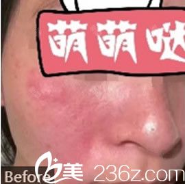 去紅血絲激光手術費用詳解，多少錢？，激光去紅血絲手術費用全面解析，費用究竟是多少？