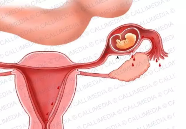 宮外孕20天最明顯的征兆，宮外孕20天的明顯征兆，早期識別與應(yīng)對的關(guān)鍵時(shí)刻