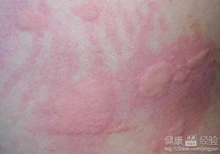 風(fēng)疹是怎么引起的，風(fēng)疹的成因解析