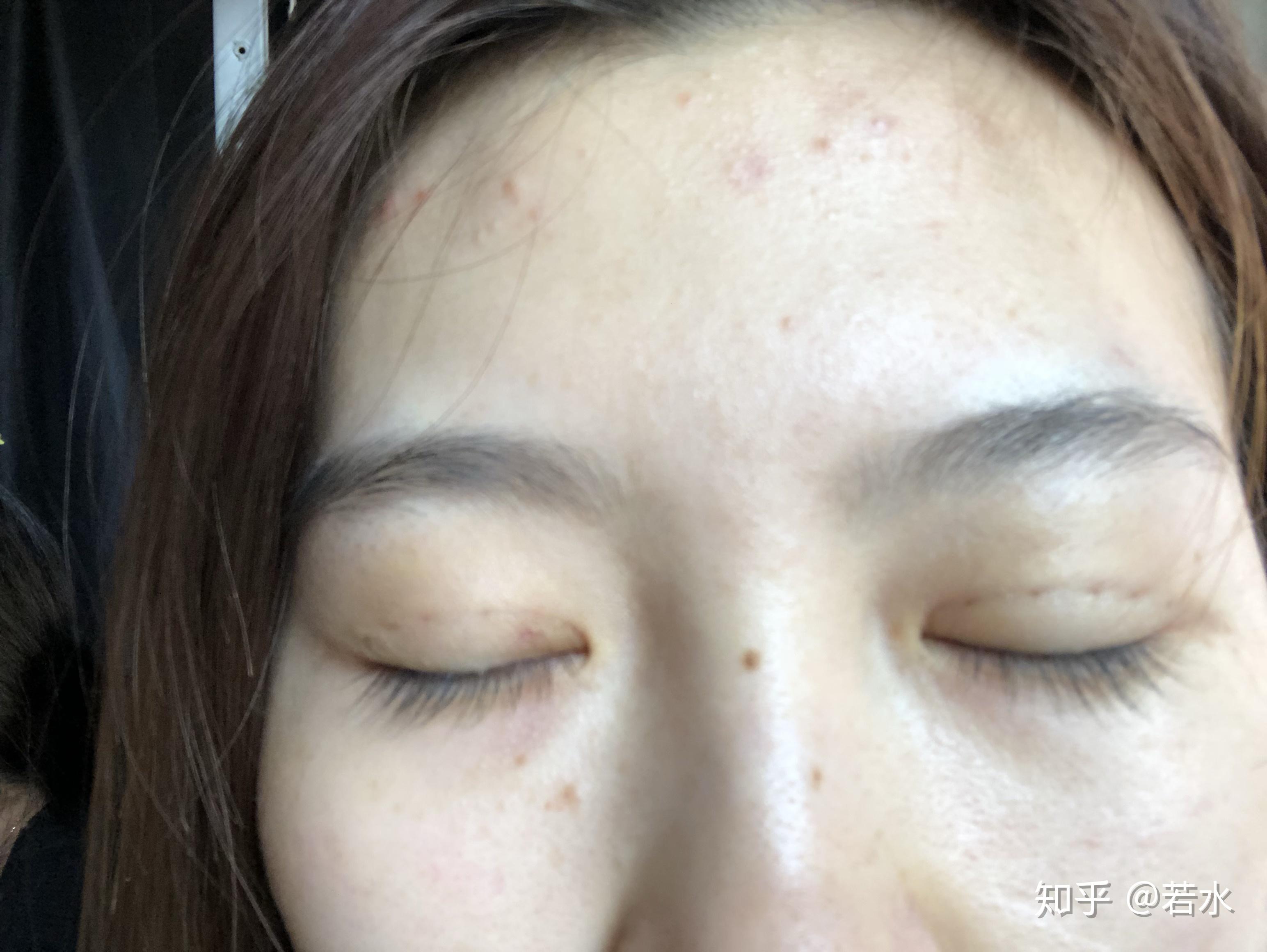 雙眼皮埋線手術(shù)效果持久性解析，持續(xù)時間與影響因素探討，雙眼皮埋線手術(shù)的持久性與影響因素深度解析