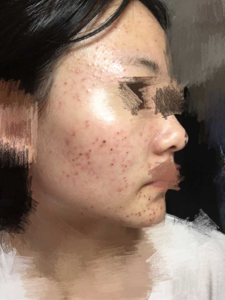 激光祛痘痘有效果嗎，深度解析與全面理解，激光祛痘效果深度解析與全面理解指南