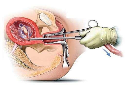流產(chǎn)最小的傷害是哪一種，探討不同流產(chǎn)方式的利弊與選擇策略，探討不同流產(chǎn)方式的利弊，尋找最小傷害的選擇策略