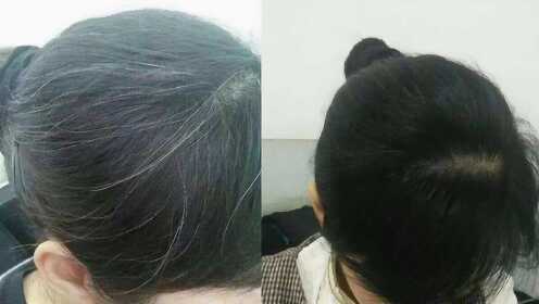 少白頭怎么調(diào)理變黑發(fā)——全方位指南，少白頭調(diào)理全攻略，如何有效變黑發(fā)？