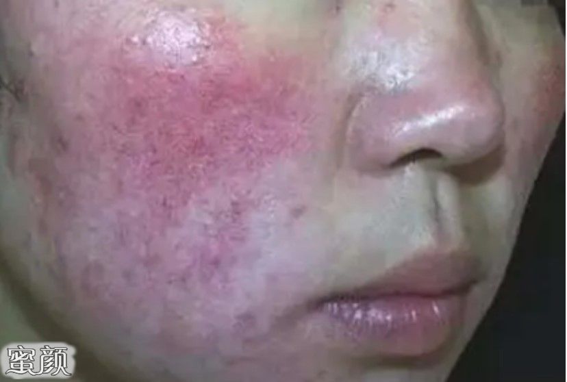 怎樣去除紅血絲最有效，全面解析紅血絲成因與有效去除方法，全面解析紅血絲成因及有效去除紅血絲的方法技巧