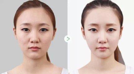 關(guān)于美白針多久打一次的全面解析，美白針注射頻率全面解析，多久打一次？