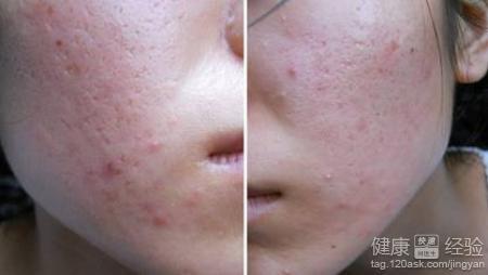 什么是痤瘡？一篇全面的SEO文章解析，全面解析，痤瘡的定義與防治——專業(yè)SEO文章解讀