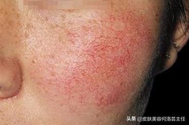 臉上有紅血絲怎么辦？全面解析治療方法，全面解析臉上紅血絲的治療方法
