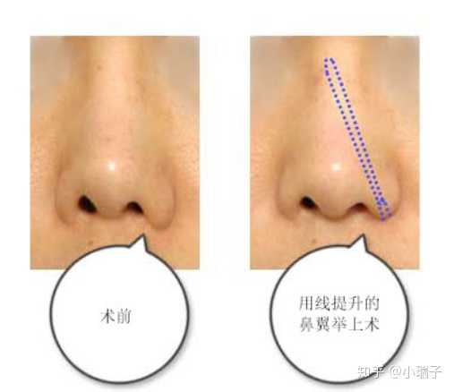 縮小鼻翼的方法，有效改善鼻翼過大的實(shí)用指南，縮小鼻翼的有效方法，實(shí)用指南助你改善鼻翼過大問題