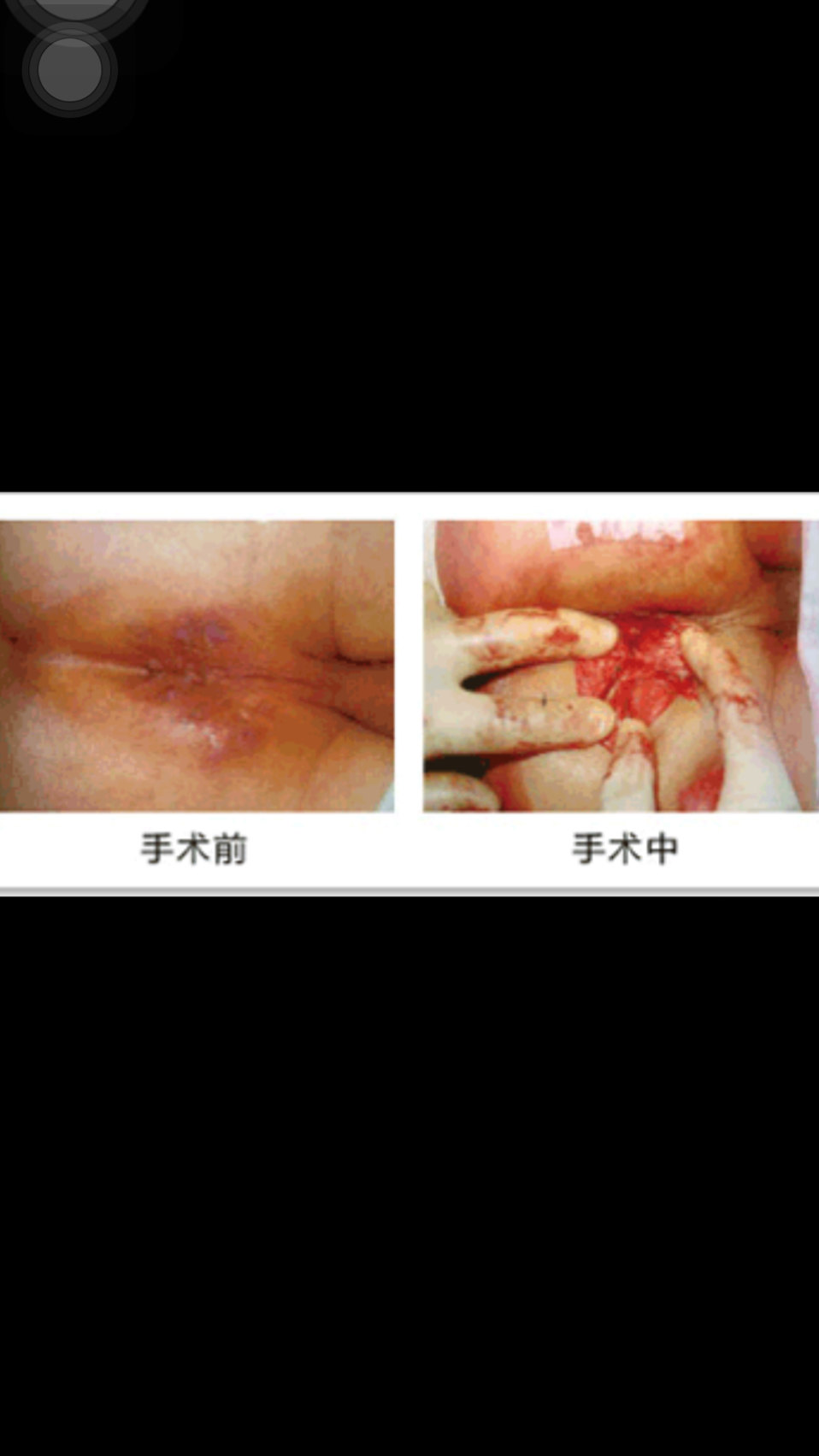 肛瘺圖片，了解癥狀、診斷與治療，肛瘺詳解，癥狀、診斷、治療及圖片參考