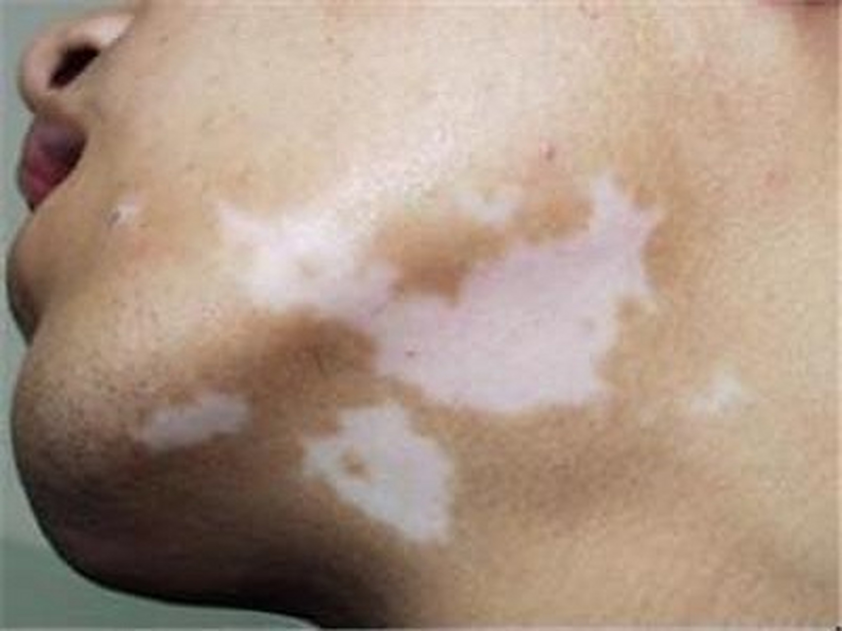 白點(diǎn)癲風(fēng)怎么治療效果最好，全面解析最佳治療方案，全面解析白點(diǎn)癲風(fēng)最佳治療方案，治療效果最大化