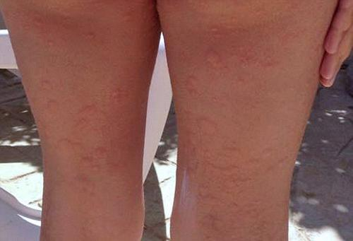 蕁麻疹的治療方法，全方位解析與應(yīng)對策略，全方位解析蕁麻疹治療方法與應(yīng)對策略