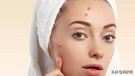 痤瘡是什么——深入了解痤瘡的成因、癥狀與治療方法，痤瘡解析，成因、癥狀及治療方法全面介紹