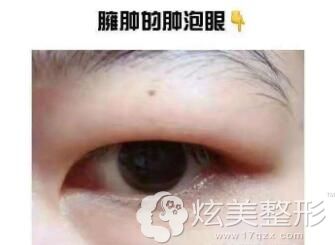 腫眼泡抽脂手術(shù)費(fèi)用詳解，多少錢？，腫眼泡抽脂手術(shù)費(fèi)用解析，手術(shù)費(fèi)用究竟是多少？